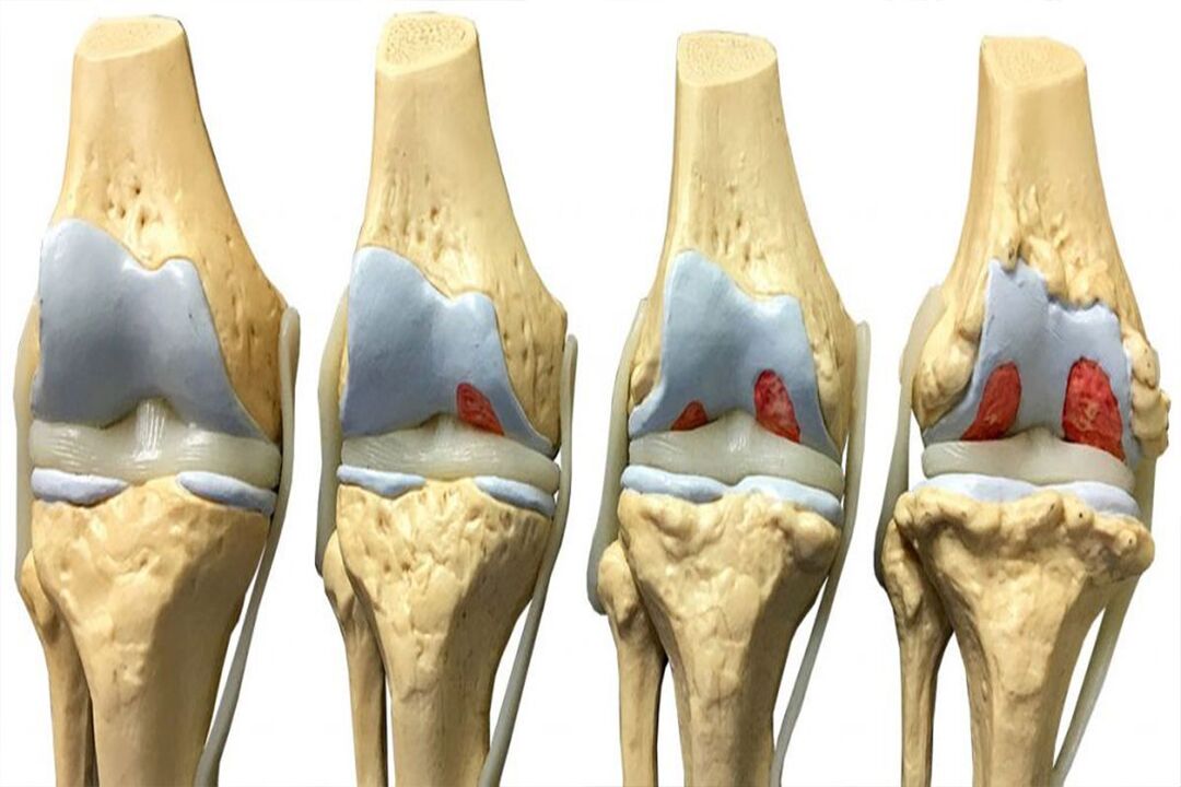 stages of arthropathy development