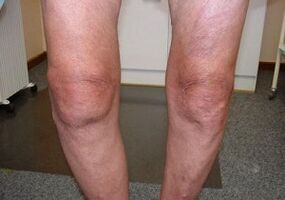 How to cure the arthritis of the knee joint