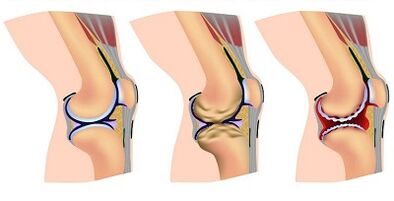 Stage of Development of Articulation Articulation of the Knee