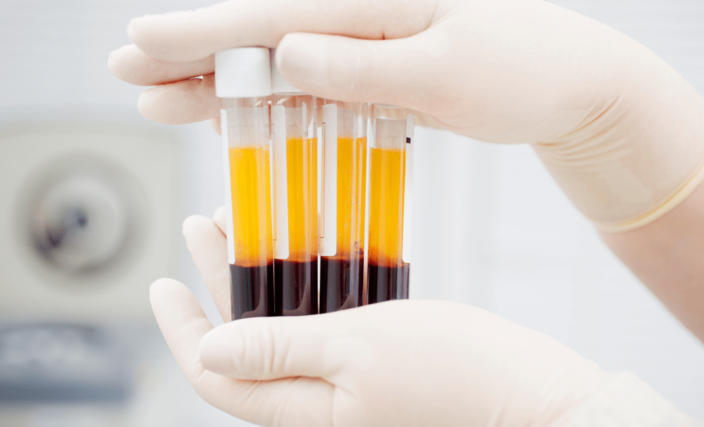 Platelet Rich Plasma for PRP Therapy for Joints